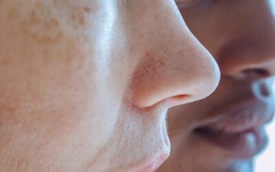 Rhinoplasty in Milwaukee: Need to Knows + What to Expect