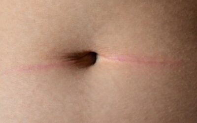 Should You Worry About Plastic Surgery Scars?