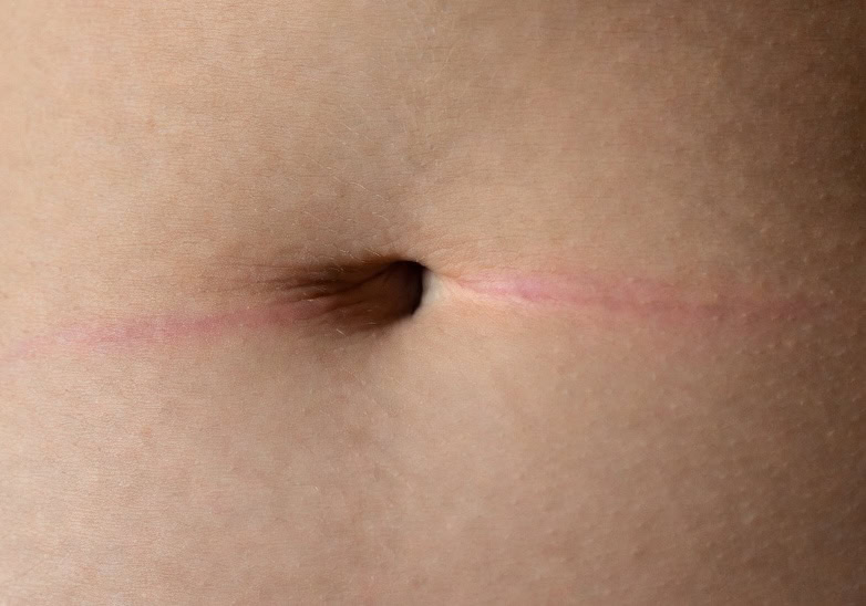 Should You Worry About Plastic Surgery Scars?