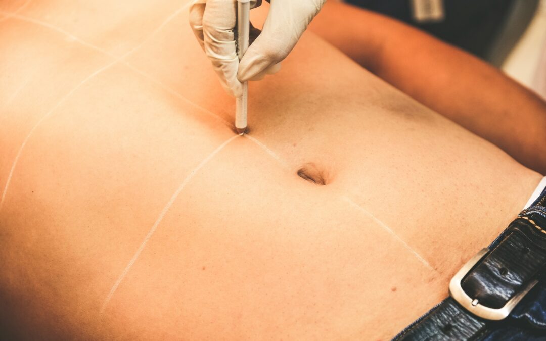 How Much Weight Can You Lose With Liposuction? The Honest Answer